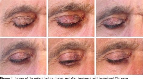 Figure 1 From Imiquimod 5 Cream For The Treatment Of Actinic Keratosis
