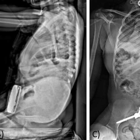 Representative Radiographs Of The Pre Operative A Posteroanterior And B