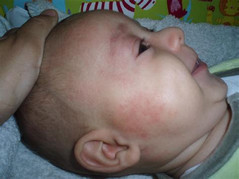 Cómo identificar alergias alimentarias en bebés Cuida tu salud con