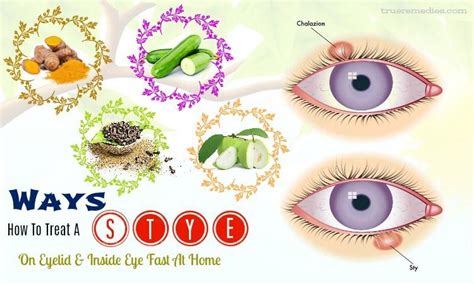 26 Ways How To Treat A Stye On Eyelid And Inside Eye Fast At Home