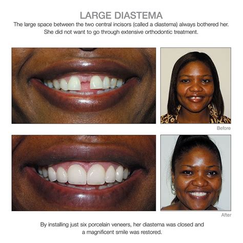 The gap will continue to close as you move towards. Diastema | Teeth dentist, Veneers teeth, Dentist