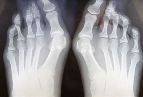 100%(1)100% found this document useful (1 vote). Salah Pilih Kasut, Boleh Kena Bunion