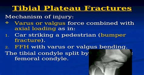 Tibial Plateau Fractures Mechanism Of Injury Varus Or Valgus Force
