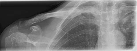 Mass In Medial Clavicle Cases Home