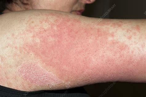 Allergic Rash Stock Image C0024042 Science Photo Library