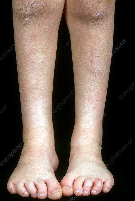 Original lyrics of club foot song by kasabian. Club Foot - Stock Image - C014/4294 - Science Photo Library