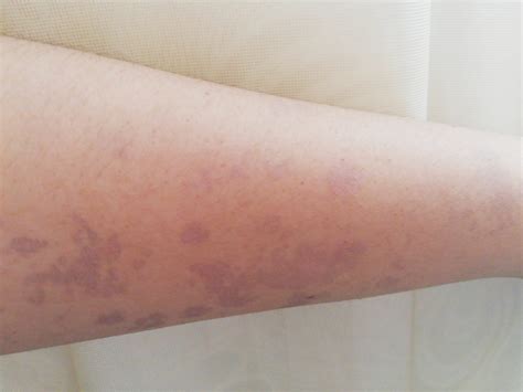 Manchas Oscuras En Los Brazos De Un Dia Para Otro Dermatologo Net