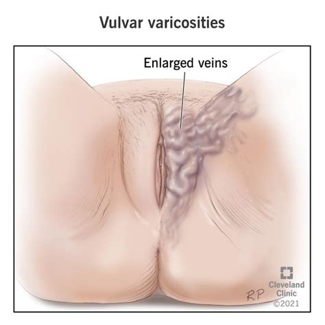 Vibrating Pulsing Vagina Causes Treatment Kienitvc Ac Ke