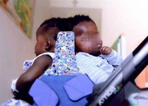 Twins Conjoined At The Head Separated Successfully Photos