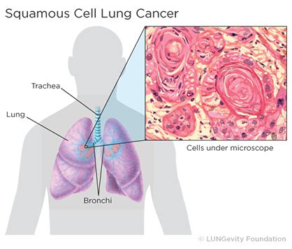 Squamous Cell Lung Cancer LUNGevity Foundation