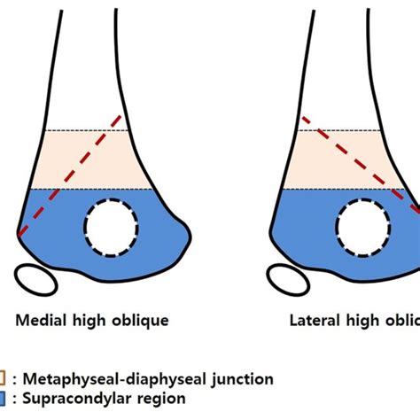 Illustration Of The High Long Oblique Supracondylar Humeral Fracture