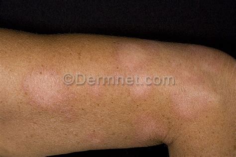 The cause of pityriasis alba is unknown, although it has been regarded as a manifestation of another skin disorder. Differential diagnosis | Dermatology Education