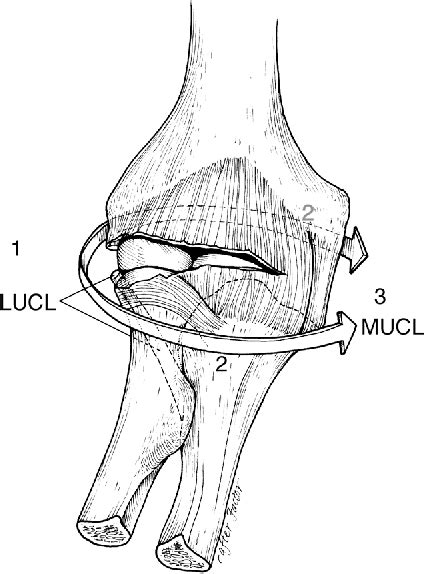 Figure 3 From Posterolateral Rotatory Instability Of The Elbow