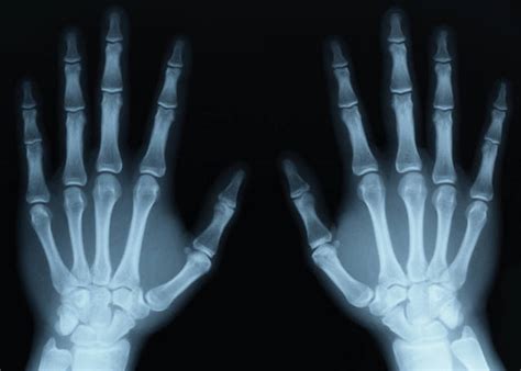 history and the evolution of x rays timeline timetoast timelines