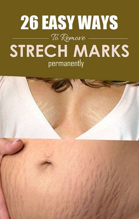 How To Use Aloe Vera To Get Rid Of Stretch Marks Stretch Marks Skin