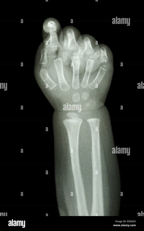 Film X Ray Forearm And Hand Show Normal Infants Bone Stock Photo Alamy