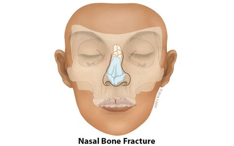 Nasal Bone Fracture Splint