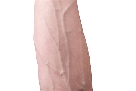 Top 60 Arm Vein Stock Photos Pictures And Images Istock