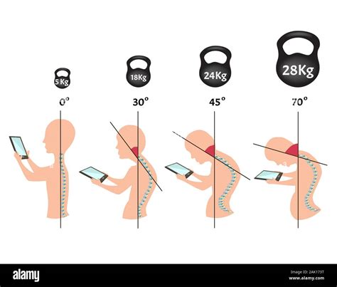 Improper Posture Symptoms Stage Text Neck Syndrome Spinal Curvature