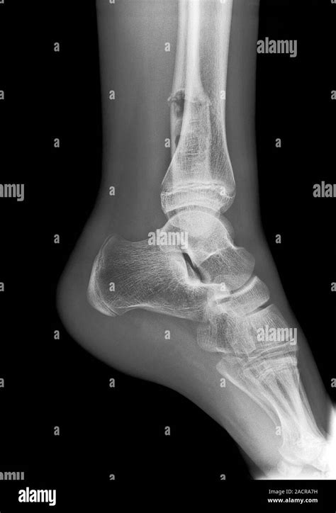 Ankle Fracture X Ray Of The Fractured Ankle Of A Patient The Bone Had