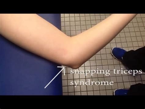 Snapping Triceps Syndrome Youtube