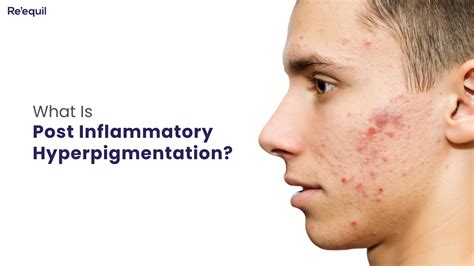 What Is Post Inflammatory Hyperpigmentation Youtube