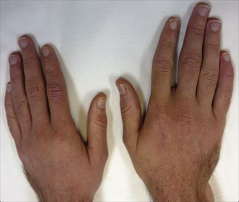 Plantar warts can be refractory to attempted therapeutic interventions. Recalcitrant Cutaneous Warts Treated With Recombinant ...