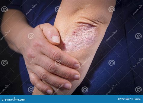 Psoriasis On The Elbow Closeup Dermatitis On Skin Ill Allergic Rash