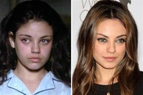 Mila Kunis Before And After Plastic Surgery