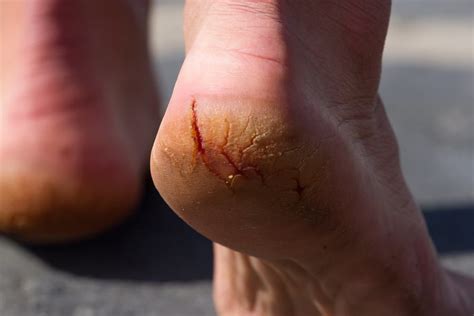List Of Various Factors And Reasons Contributing To Cracked Heels