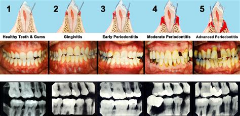 Deep Cleanings Stop Bone Loss Due To Periodontal Disease Jennifer