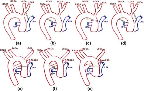 Ductus Arteriosus Location In Relation To Aortic Arch Position