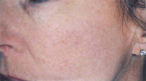 Rid Your Skin Of Age Spots And Lesions With Our Photofacials