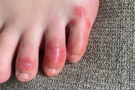 Covid Toes Red Sore And Sometimes Itchy Swellings Possible Rare