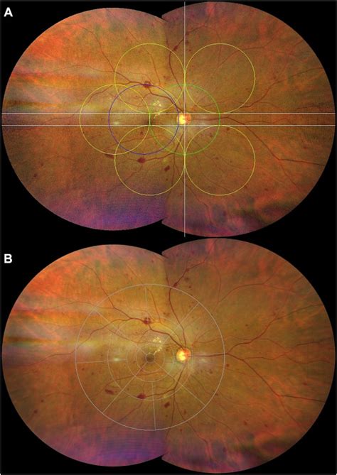 Association Of Diabetic Lesions And Retinal Nonperfusion Using