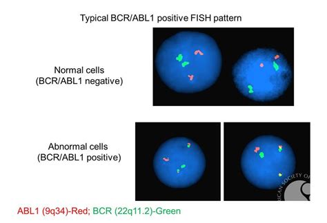 It also shows how drugs targeting this protein can help treat chronic myeloid leukemia (cml), a cancer of the white. BCR-ABL FISH
