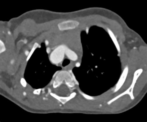 Coarctation Of The Aorta With Extensive Collaterals Chest Case