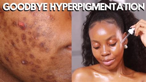How To Get Rid Of Hyperpigmentation For Dark Skingoodbye