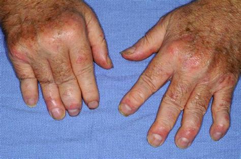 Los S Ntomas Y El Tratamiento De La Artritis Psori Sica