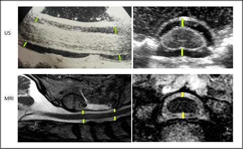 Upper Line Ultrasonography Of The Spinal Cord In Sagittal And Axial