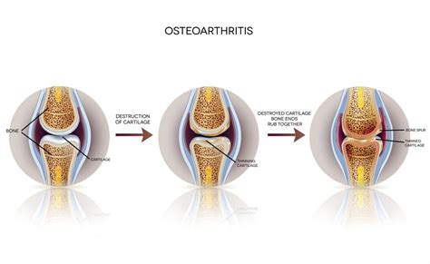 Stages Of Osteoarthritis