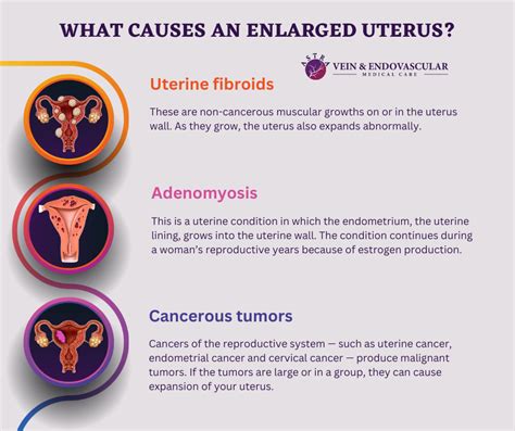 Enlarged Uterus Vein And Endovascular Medical Care