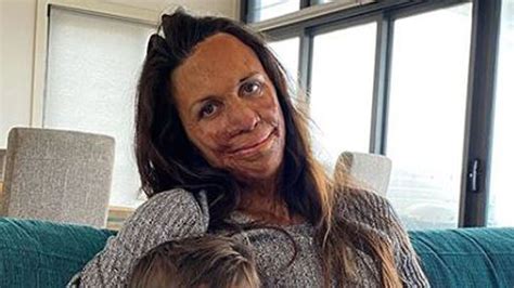 Turia Pitt S Instagram For Fire Affected Businesses Overwhelmed By Support Honey