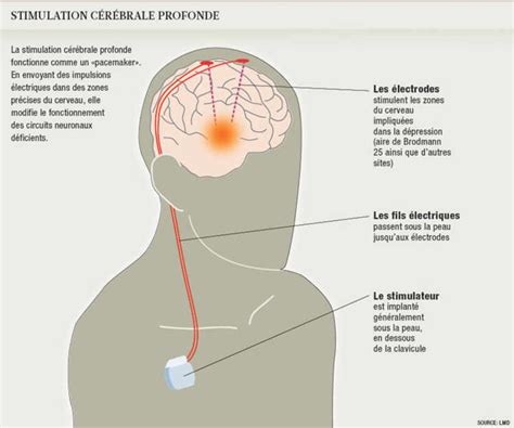 La stimulation cérébrale profonde qui consiste envoyer une stimulation électrique à une région spé parkinson découverte en 1817 par un médecin britannique, james parkinson, la maladie de parkinson touche 4 millions de. Du courant à haute fréquence pour combattre la dépression ...