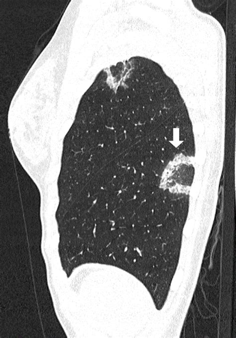 Ct Scan Coronal Plane Showing A Subpleural Consolidation With A
