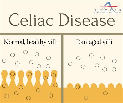 What Is Celiac Disease Access Health Care Physicians Blog