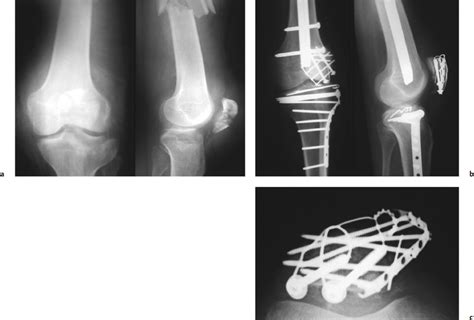 Patella Fractures And Injuries To The Knee Extensor Mechanism