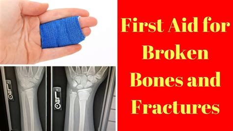 First Aid For Broken Bones And Fractures Youtube