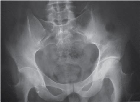 Radiograph Of The Pelvis Showing Global Narrowing Of The Right Hip