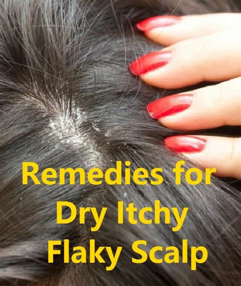 Best 25 Itchy Flaky Scalp Ideas On Pinterest Treatment For Dry Scalp